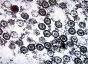 M,10y. | herpes virus - herpetic encephalitis M,10y. | herpes virus - herpetic encephalitis